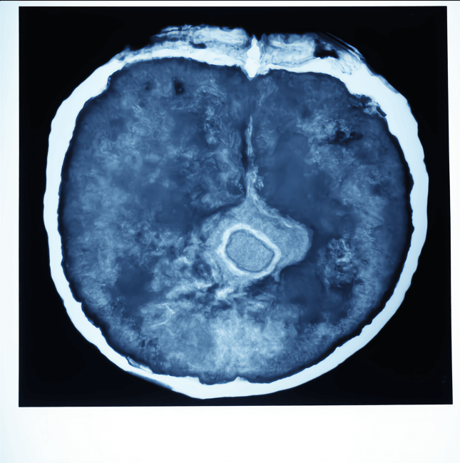 CT scan of a female pelvis showing a large irregular uterine mass suggestive of uterine sarcoma – heterogeneous density, with areas of necrosis and contrast enhancement.