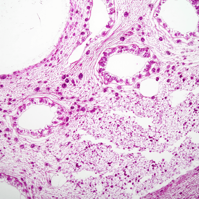 microscopic image of Kaposi sarcoma