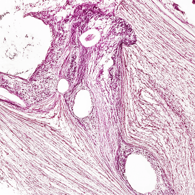 microscopic image of uterine leiomyosarcoma – dense fascicles of spindle-shaped malignant cells with atypical nuclei, high mitotic activity, eosinophilic cytoplasm.